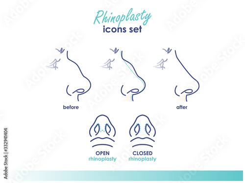 Rhinoplasty. Open and closed rhinoplasty. Side and bottom view. Plastic surgery nose. Medical and beauty line illustration