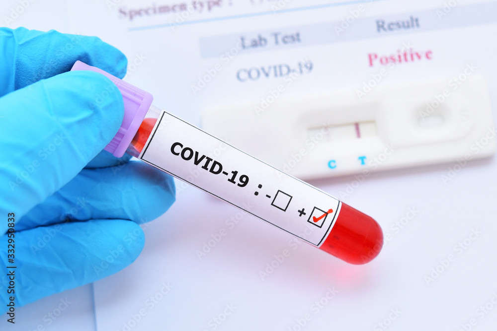 Obraz premium Positive test result by using rapid test device for COVID-19 virus, novel coronavirus 2019 found in Wuhan, China