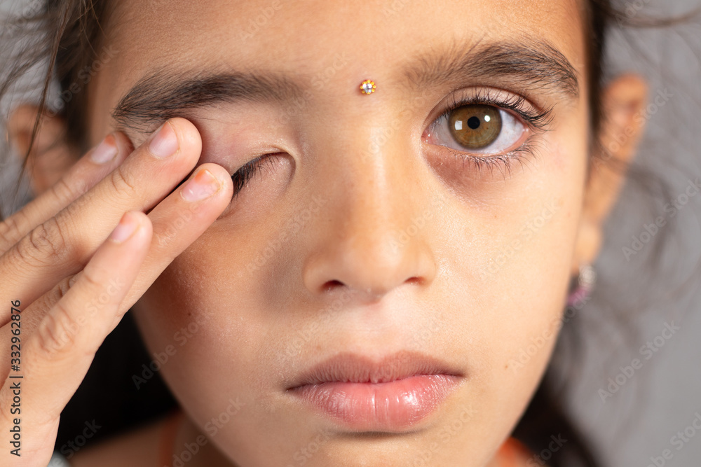 Extreme close up of child rubbing her eyes - concept showing to prevent and Avoid touching your eyes. Protect from COVID-19 or coronavirus infection or outbreak - Don t Touch Your eyes. Extreme close up of child rubbing her eyes - concept showing to prevent and Avoid touching your eyes. Protect from COVID-19 or coronavirus infection or outbreak - Don t Touch Your eyes.