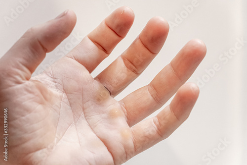 Hand with blister and callus on white background