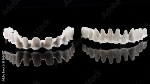two dental titanium beams with Apak material on the lower and upper jaws of the patient, taken with reflection