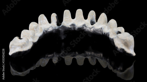 dental titanium beam with Apak material on the lower jaw of the patient, removed from the inside photo