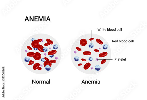 Vector illustration of anemia and normal amount of red blood cells.