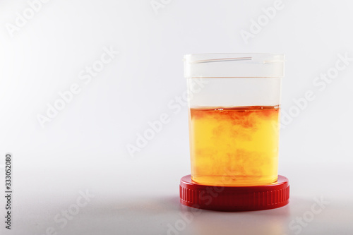 Canvastavla blood in urine analysis as an idea of urogenital system disease and prostate cancer