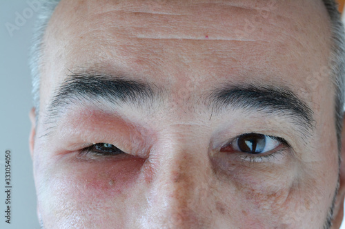 Swollen eye from the sting of the wasp