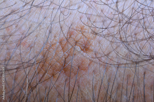 Sample of seborrheic keratosis close up