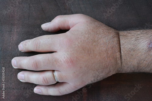 Swollen fist due to the sting of the wasp