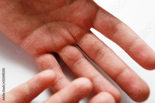 male hand with calluses in the palm
