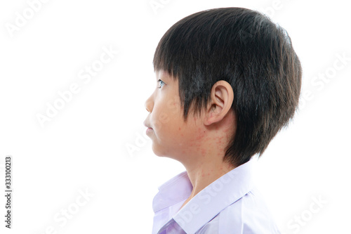 asian boy screatching his neck with rash on white background isolated