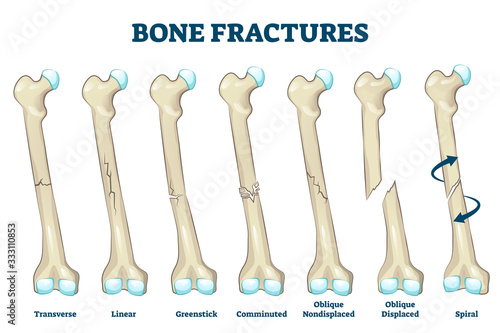 Bone fractures vector illustration