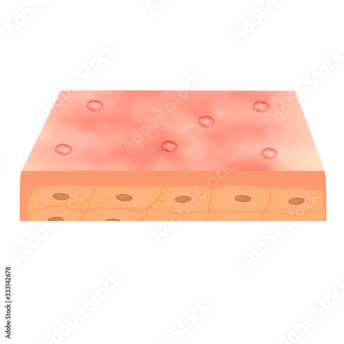 Closed comedones. Acne on the skin. Dermatological and cosmetic diseases on the skin of the face acne. Infographics. Vector illustration on isolated background.