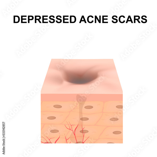 Atrophic scars. Acne scar. The anatomical structure of the skin with acne. Vector illustration on isolated background.