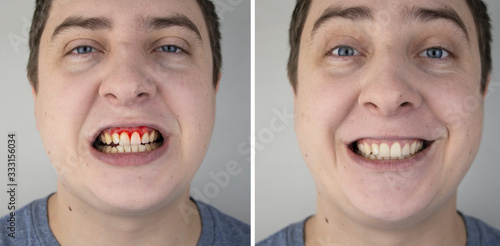 A man has gum bleeding. Photos before and after treatment of periodontitis, gingivitis and bleeding gums. The concept of prevention of oral diseases and treatment by a periodontist photo