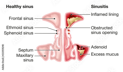 Healthy sinus and sinusitis, medical illustration, labeled photo