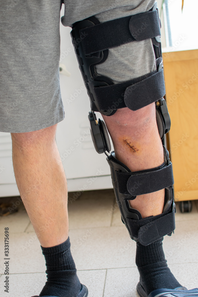Man standing and wearing a knee brace with a big scar from an anterior  cruciate ligament surgery.Sport injuries concept. Stock Photo