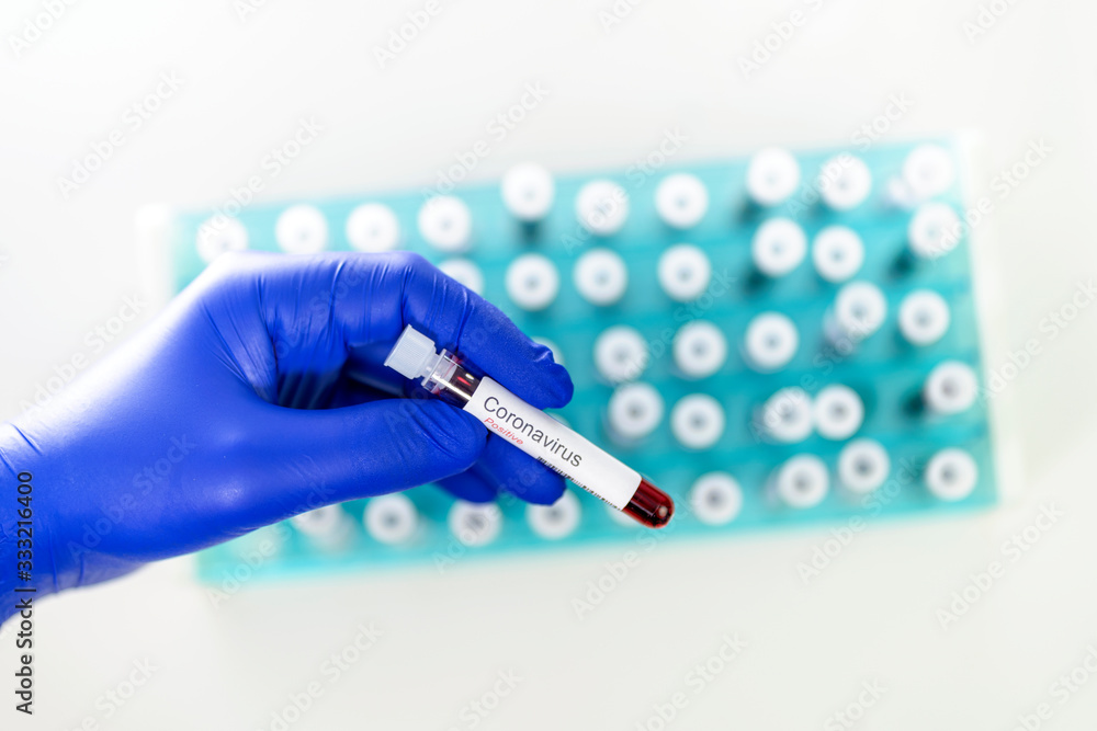 Obraz premium Health worker holds one test-tube indicating positive results of corona virus test. Many blood tube-tests as a background.