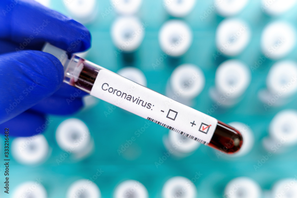 Obraz premium Health worker holds one test-tube indicating positive results of corona virus test. Many blood tube-tests as a background.