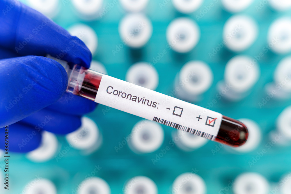 Obraz premium Health worker holds one test-tube indicating positive results of corona virus test. Many blood tube-tests as a background.