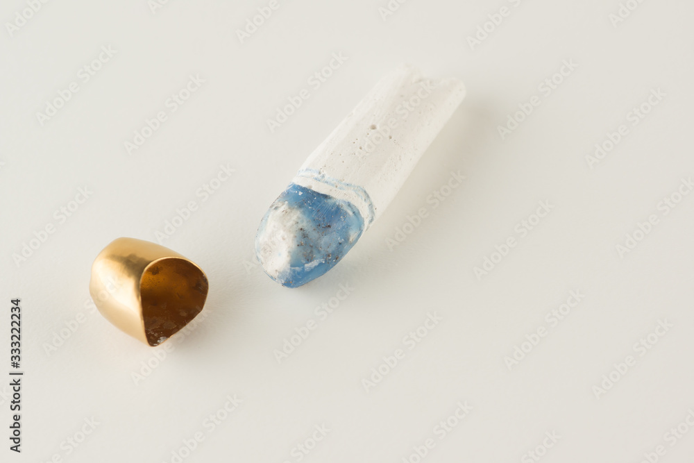 Artificial tooth crown Artificial tooth crown
