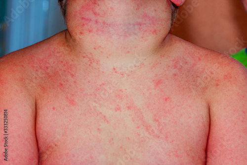 A child with severe heat rash on his neck and chest coused by warm and humid summer.