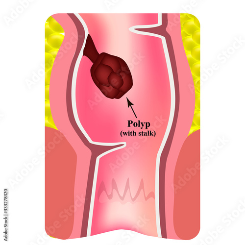 Polyps in the rectum. The structure of the rectum of the intestine. Types of polyps in the colon. Infographics. Vector illustration on isolated background.