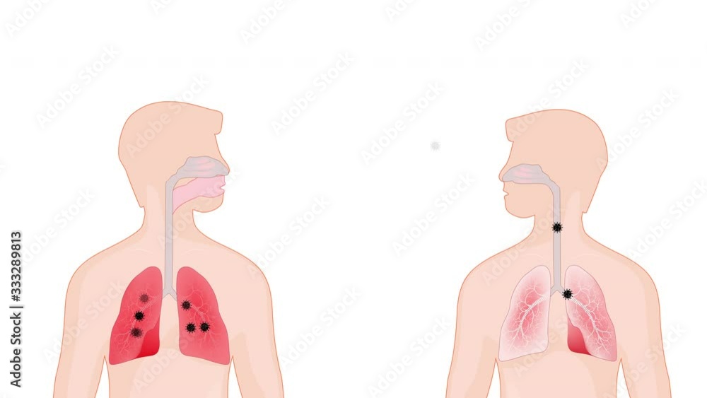 Virus. human-to-human transmission. contamination of virus. Coronavirus in lungs Virus. human-to-human transmission. contamination of virus. Coronavirus in lungs