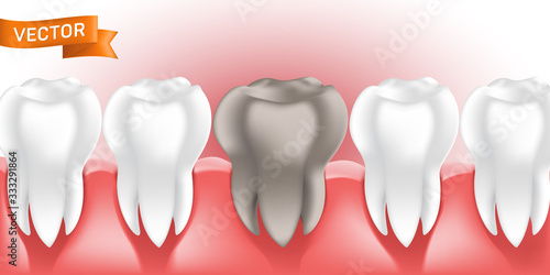 White healthy and clean human teeth in the gum with tooth decay or caries, 3D style vector illustration, can be used as dental and medicine concept element in web design, advertising and print layout