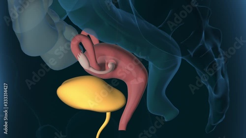 Endometriosis, female disease, 3d educational, medical animation