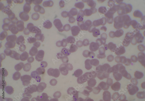 Blood parasite infection red blood cells malaria.