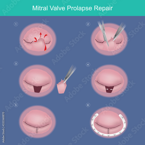 Mitral Valve Prolapse Repair. The method repair heart valve by surgery removed damaged or abnormal leaked segment and used Synthetic material ring (medical parts) for tissue strength.