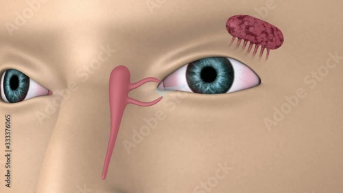 Biomedical animation of a blocked tear duct in human eyes. photo