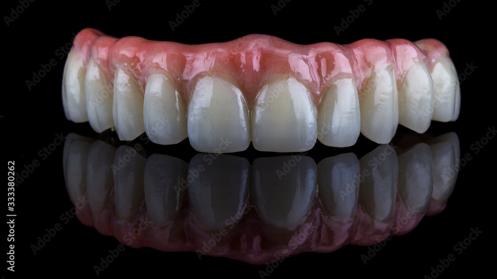 high-quality dental prosthesis made of titanium beam and ceramics for fixation to the upper jaw of the patient high-quality dental prosthesis made of titanium beam and ceramics for fixation to the upper jaw of the patient