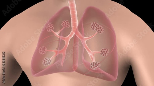 Biomedical animation of emphysema in the human lungs. photo