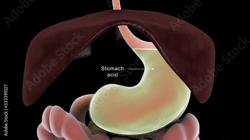 Biomedical animation of a hiatal hernia in the human stomach causing GERD.