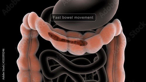 Biomedical animation showing irratable bowel syndrome (IBS).