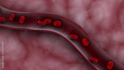 Biomedical animation of an ischemic stroke in the brain.