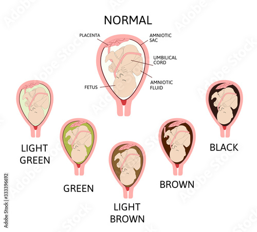 Color of amniotic fluid in the amniotic sac. normal and danger variants.