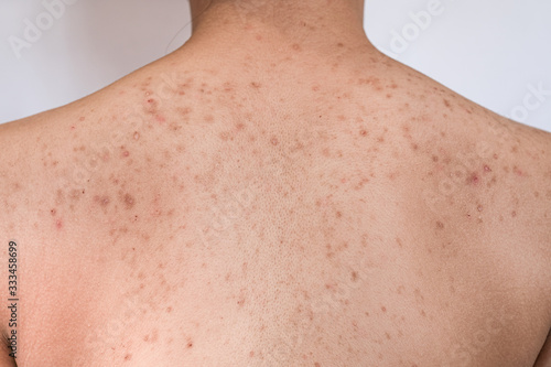 Asian teenage girls scratching pimples on the back. With many red spots on the back.
