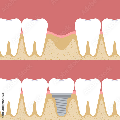 Dental implantation. A prosthesis among ordinary teeth - before and after. Vector illustration