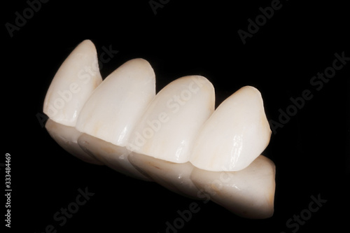 Zahnkrone Veneer aus Vollkeramik photo