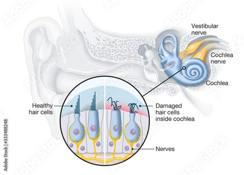 Tinnitus, healthy and damaged hair cells inside cochlea, medical illustration