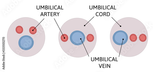 Mutual position of the umbilical cord vessels