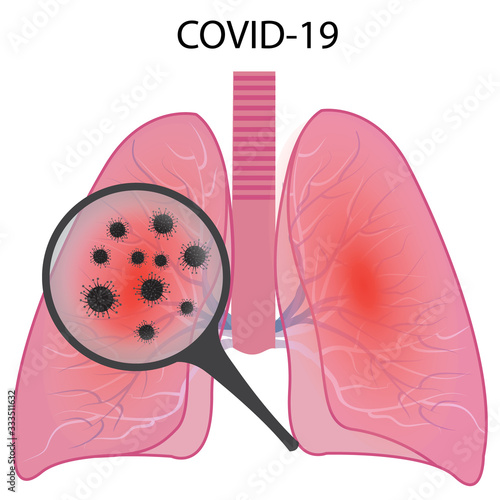 Lungs affected with coronavirus infection COVID19