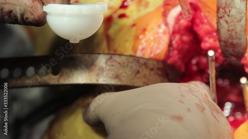 Surgeon installs a polyethylene liner of acetabular cup into the articular pit during the endoprosthetics surgery   photo