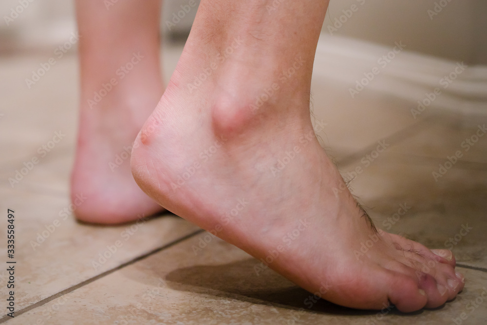 Close up view of an Adult male foot with a bony protrusion called Haglund's deformity on his heel Close up view of an Adult male foot with a bony protrusion called Haglund's deformity on his heel
