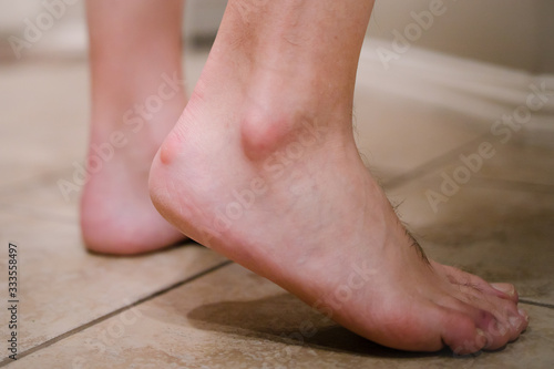 Close up view of an Adult male foot with a bony protrusion called Haglund's deformity on his heel