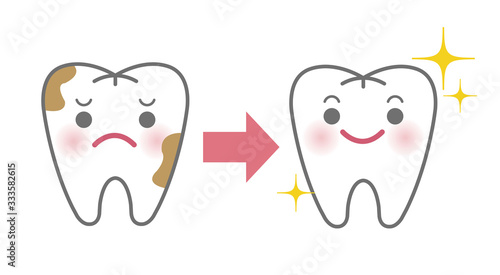 PMTC（歯の汚れ・歯垢・歯石除去イメージ）