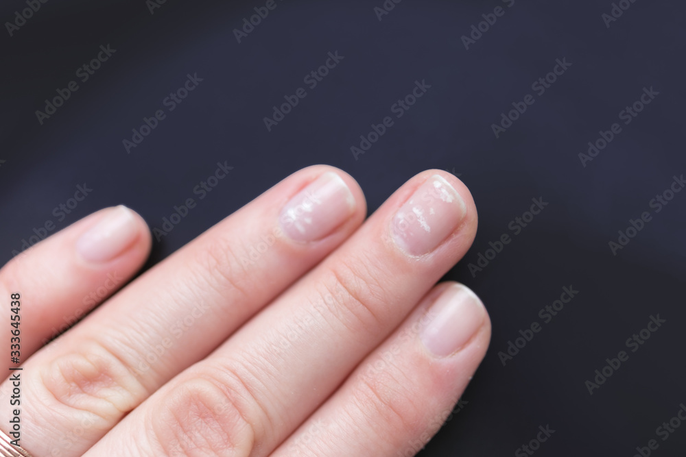 Close up of woman fingernails with deficiency of calcium and zinc. White dots. Selected focus. Close up of woman fingernails with deficiency of calcium and zinc. White dots. Selected focus.