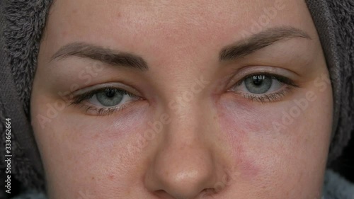 Young girl with an allergic reaction on the face and eyes, Quincke's edema. Swelling of the face from nose to eyes in a young woman. Angioedema close up view photo