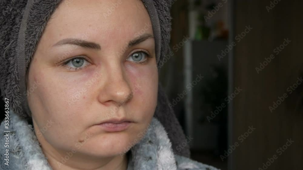Young girl with an allergic reaction on the face and eyes, Quincke's ...
